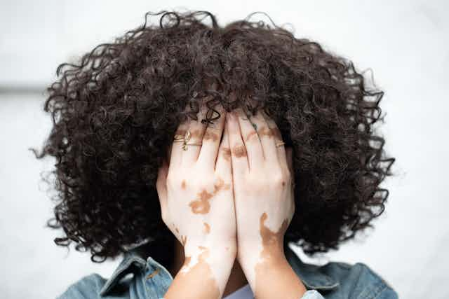 Woman with vitiligo