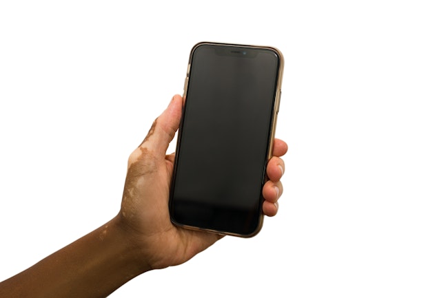 Hand with vitiligo holding phone