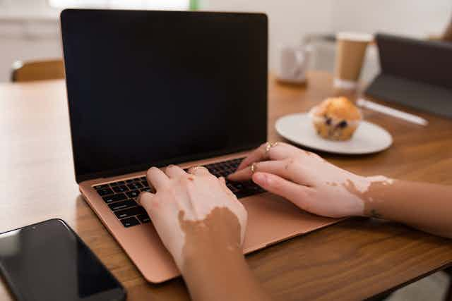 Hands with vitiligo typing on a laptop